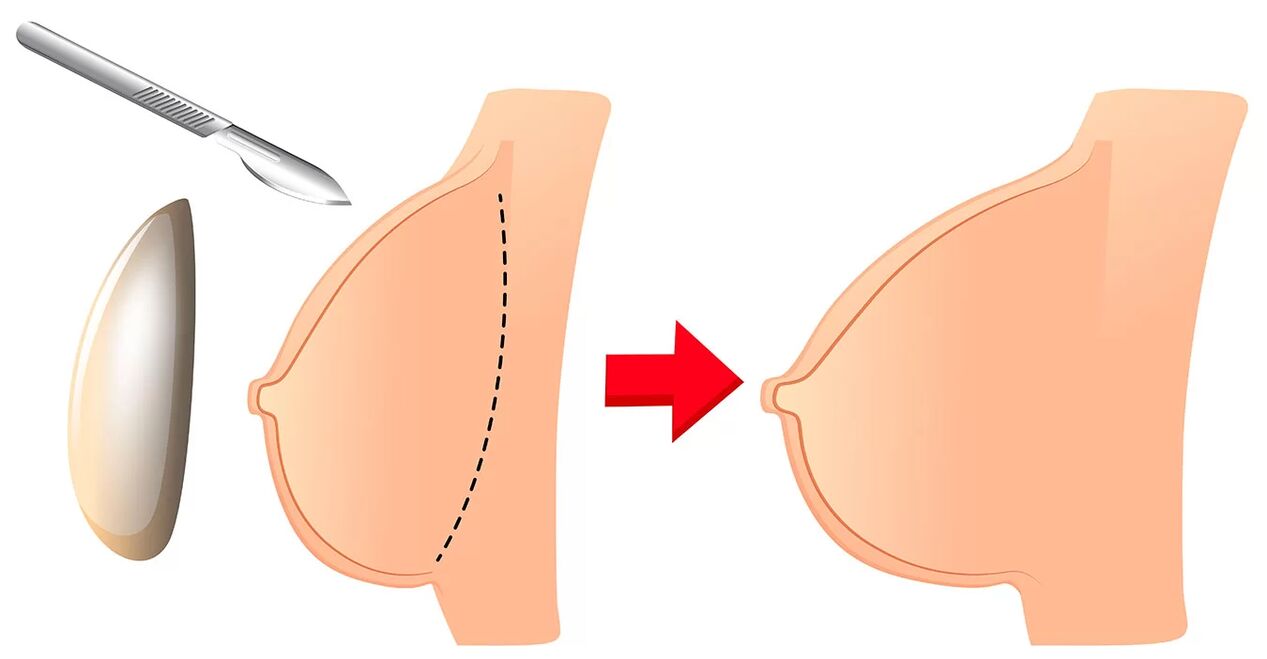 Aumento mamario con implante