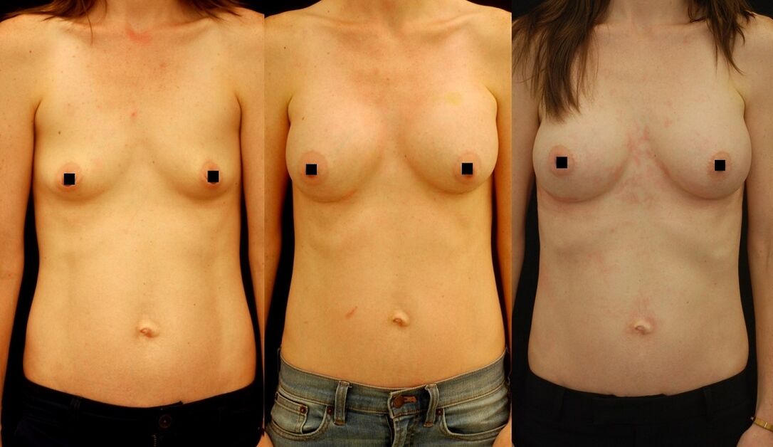 O resultado da inxección de aumento de mama